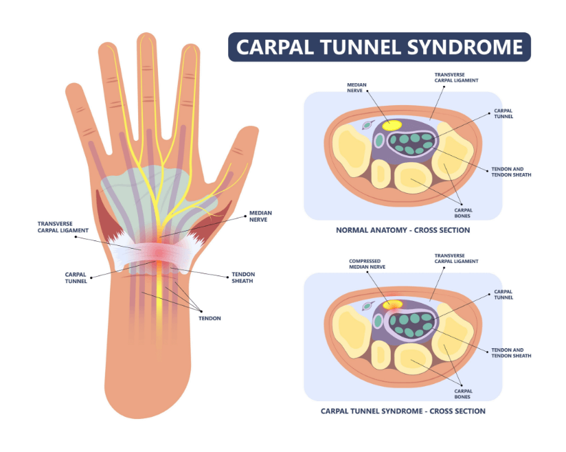 Carpal tunnel syndrome diagram
