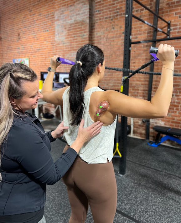 Therapist performing dry needling and cupping therapy on a patient in Tacoma.