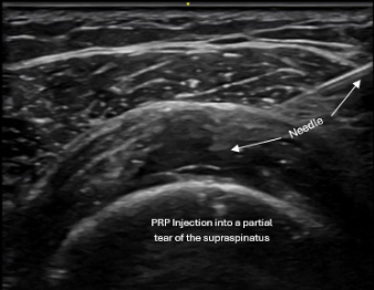 Real-time ultrasound guidance showing precise needle placement during procedure