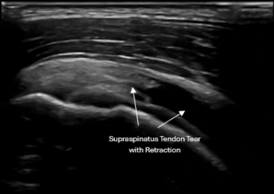 Musculoskeletal Ultrasound evaluating rotator cuff injury in active adult