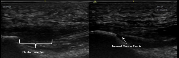 Dynamic musculoskeletal ultrasound comparing injured and non-injured tissue