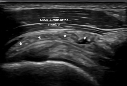 Dynamic shoulder ultrasound exam showing acute bursitis with rotator cuff tear in active adult