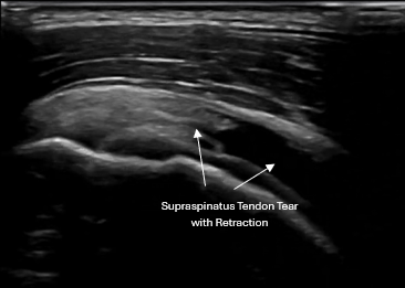 Musculoskeletal ultrasound image showing rotator cuff tendon injury