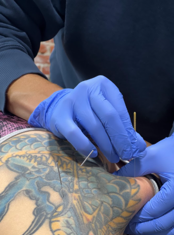 Dry needling used to reduce muscle tension and improve shoulder movement after injury