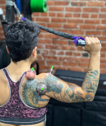 Cupping therapy used to address soft tissue restrictions surrounding shoulder injury