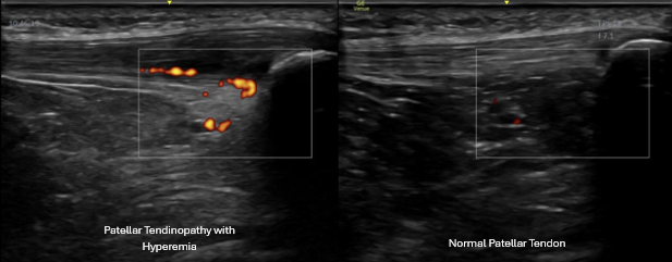 Dynamic knee ultrasound exam comparing injured and non-injured tendon tissue
