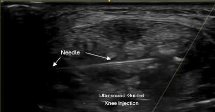 Ultrasound-guided knee injection precisely targeting tendon and joint pathology
