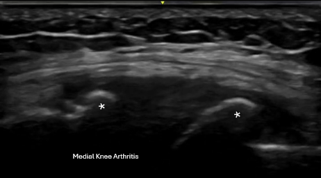 Real-time musculoskeletal ultrasound image showing arthritis of the knee