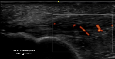 Diagnostic ultrasound evaluation of mid-portion Achilles tendinopathy with hyperemia