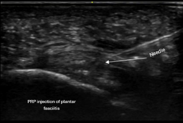Ultrasound-guided PRP injection targeting plantar fascia pathology