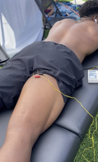 Dry needling used to address muscular and fascial restrictions contributing to hip pain